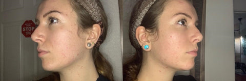 Antes e Depois — 12 Semanas Cicatrices