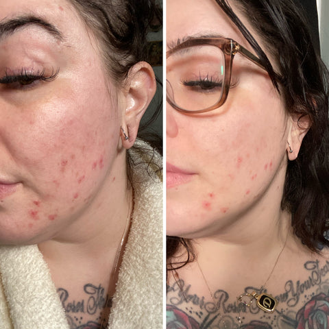 Antes e Depois — Pele Mais Luminosa