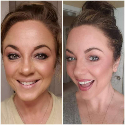 Antes e Depois — Rugas e Linhas Finas
