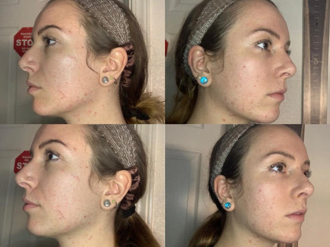 Antes e Depois Acne — 8 Semanas