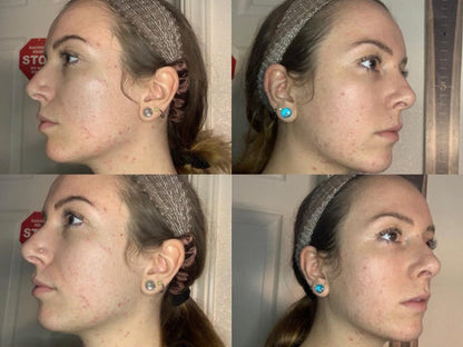 Antes e Depois Acne — 8 Semanas