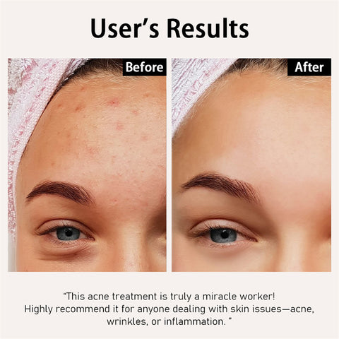 Antes e Depois - Acne