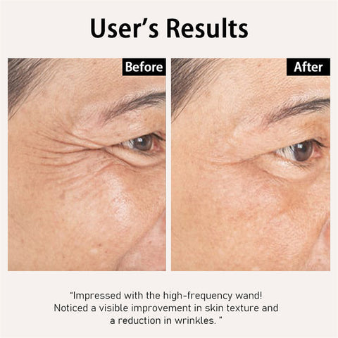 Antes e Depois - Rugas